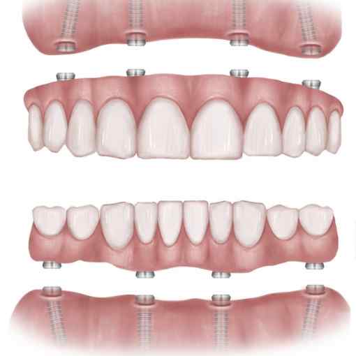 All on 4 dental implants Turkey 