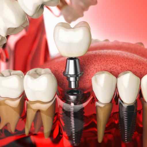 How Do Dental Implants Work?