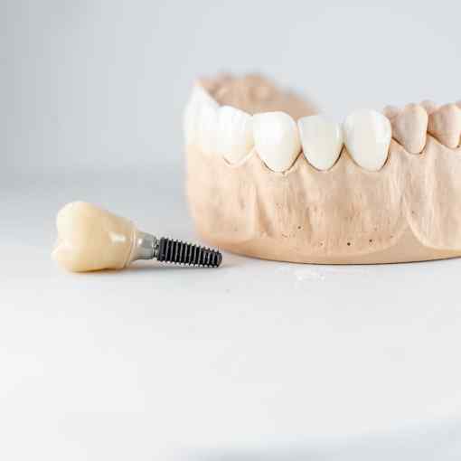 Risk of Dental Implants