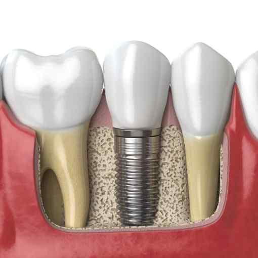 What are Dental Implants?