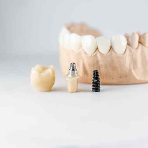 Getting Your Artificial Tooth (Dental Crowns)
