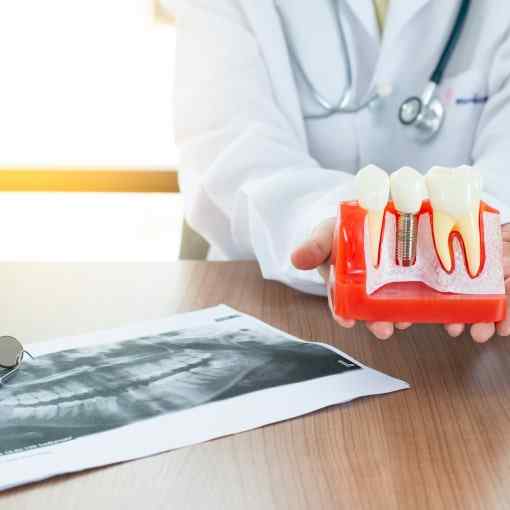 Why Would You Need a Dental Implant?