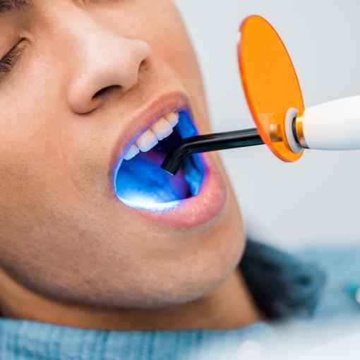 Professional Teeth Whitening