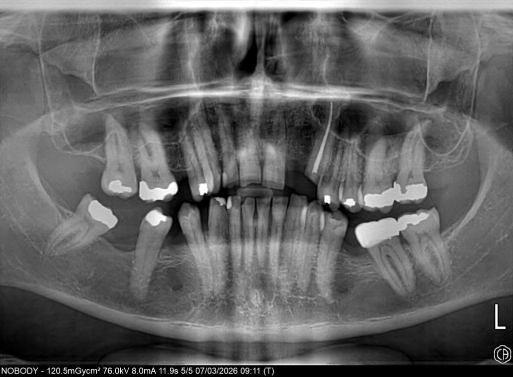 Smile Dental Turkey Pre-operative panoramic X-ray showing the patient's existing natural teeth, old restorations and overall wear before a full-mouth makeover