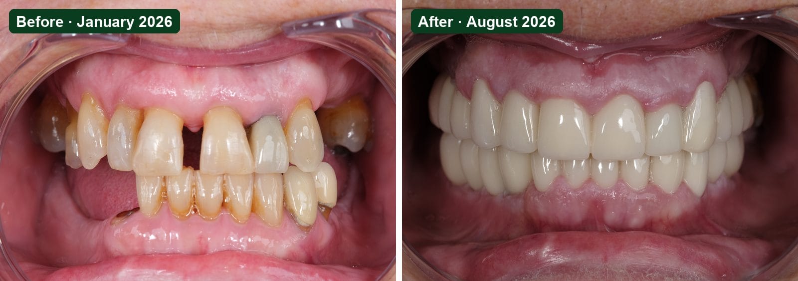 Smile Dental Turkey Front view before and after: missing back teeth, a gap between the upper front teeth and a darkened front tooth in January 2026, and 24 zirconium crowns on 9 dental implants and natural teeth in August 2026