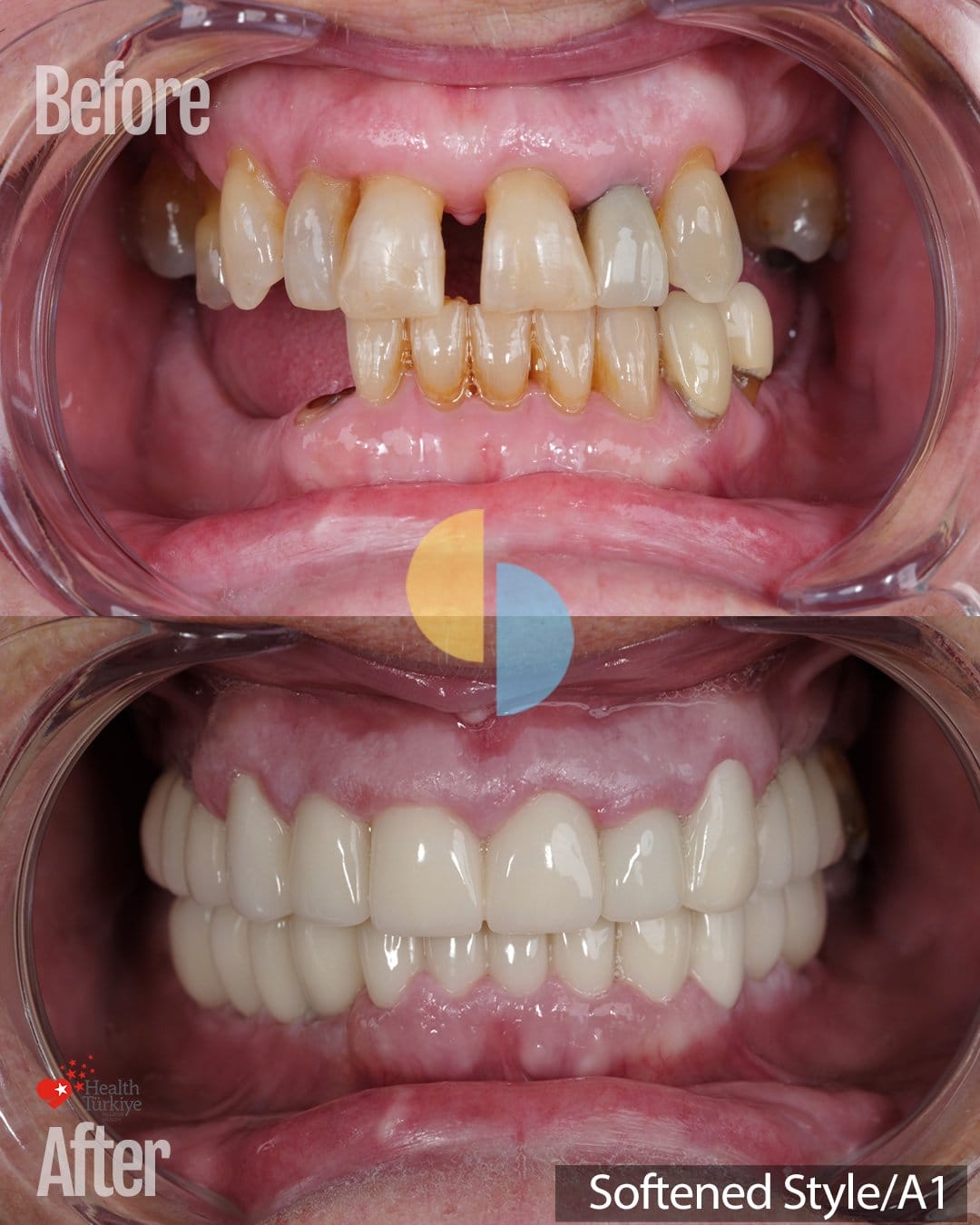 Smile Dental Turkey Retracted before and after view: gaps, a darkened front tooth and tartar before, and 24 zirconium crowns in shade A1 after