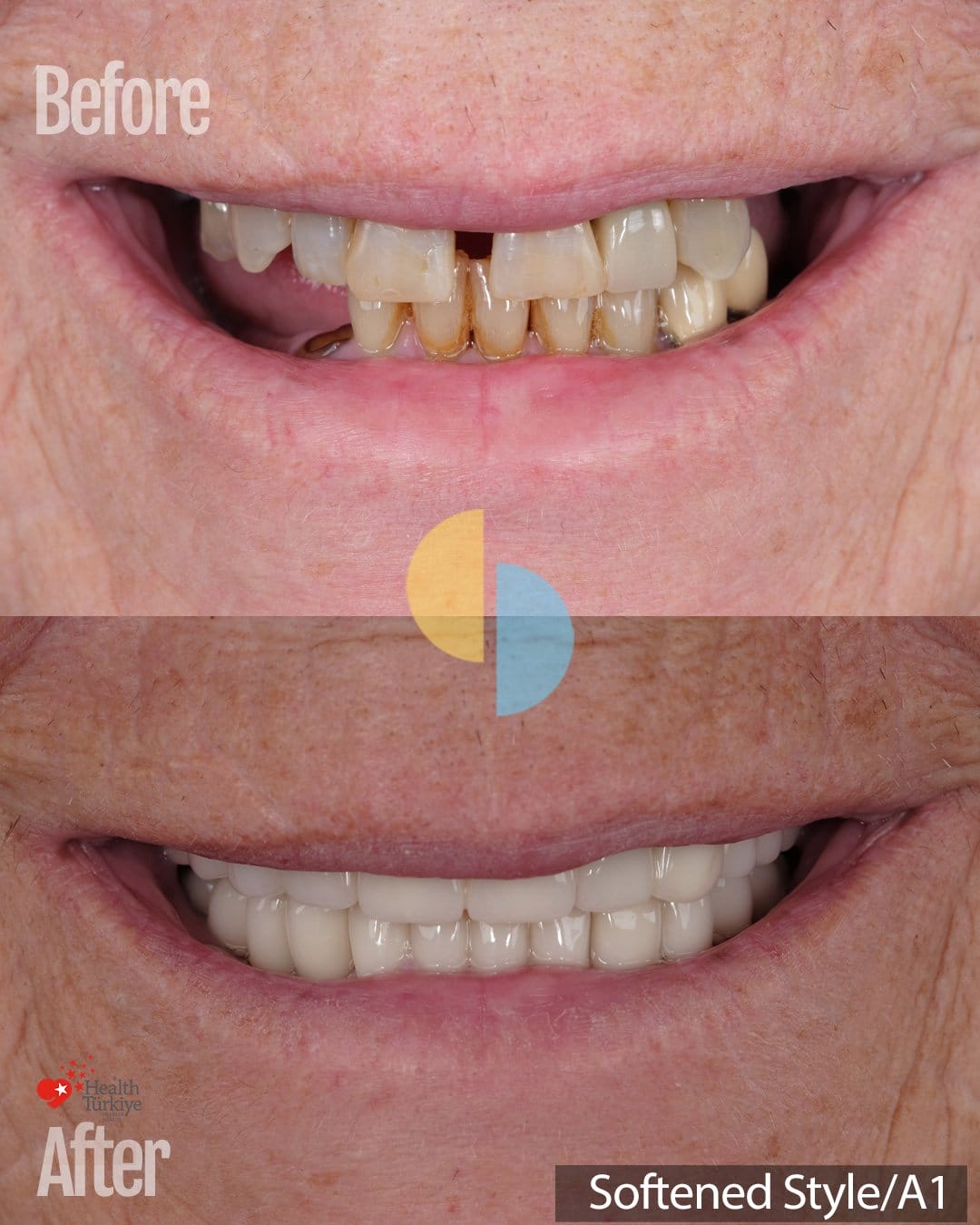 Smile Dental Turkey Smile before and after a full-mouth restoration: worn, stained teeth with a gap between the upper front teeth, then 24 zirconium crowns in shade A1, Softened Style