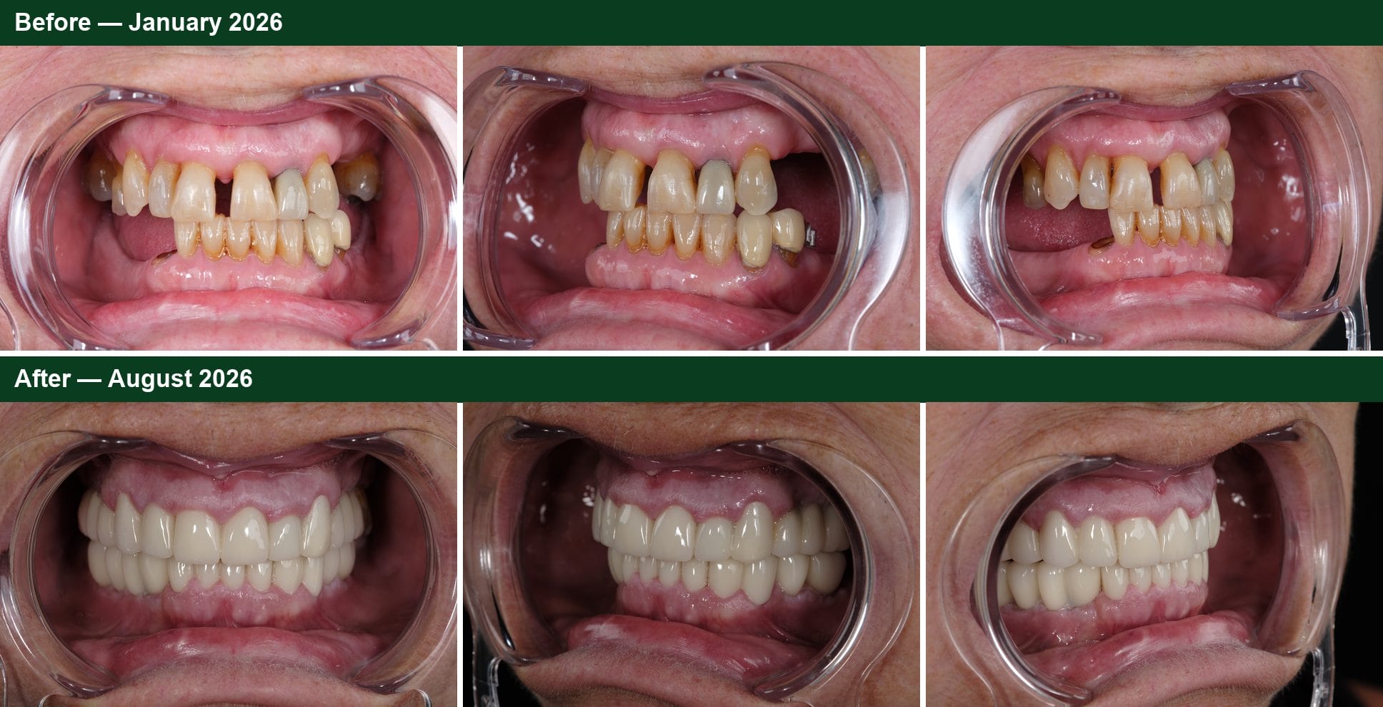 Smile Dental Turkey Before and after comparison from three angles: missing back teeth, staining and a front gap in January, and a complete set of zirconium crowns on implants and natural teeth in August