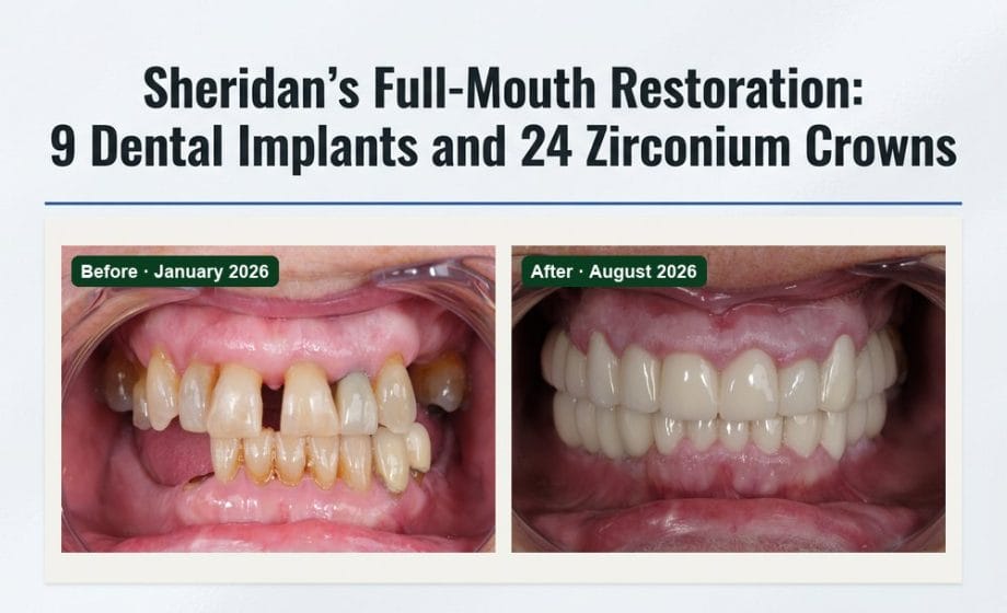 Smile Dental Turkey Sheridan's full-mouth restoration case study: front view before treatment in January 2026 and after 9 dental implants and 24 zirconium crowns in August 2026