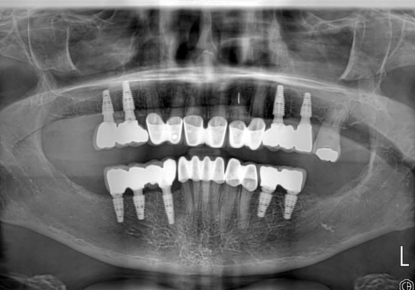 Smile Dental Turkey Final panoramic X-ray showing nine Neodent dental implants supporting bridges at the back of both jaws, with zirconium crowns on the natural front teeth