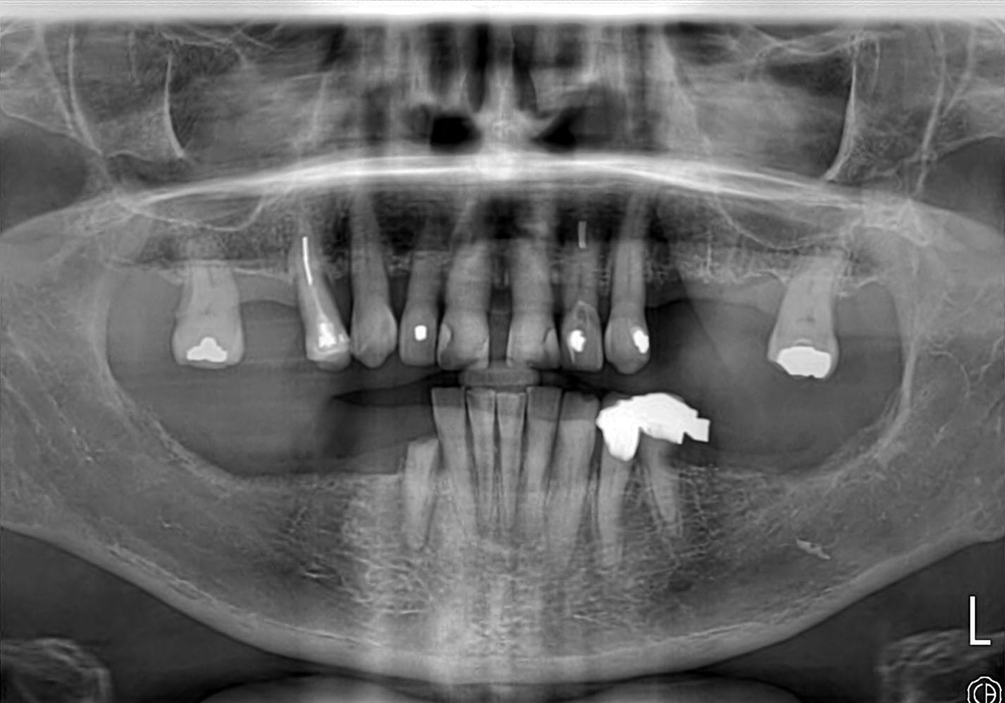 Smile Dental Turkey Panoramic X-ray before treatment showing missing back teeth in all four quadrants, an old metal bridge in the lower left and a gap between the upper front teeth