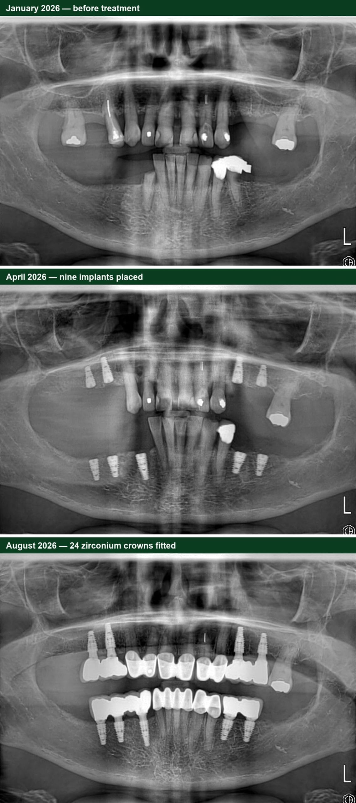Smile Dental Turkey Three panoramic X-rays showing the treatment timeline: January before treatment, April with nine dental implants placed, and August with 24 zirconium crowns fitted