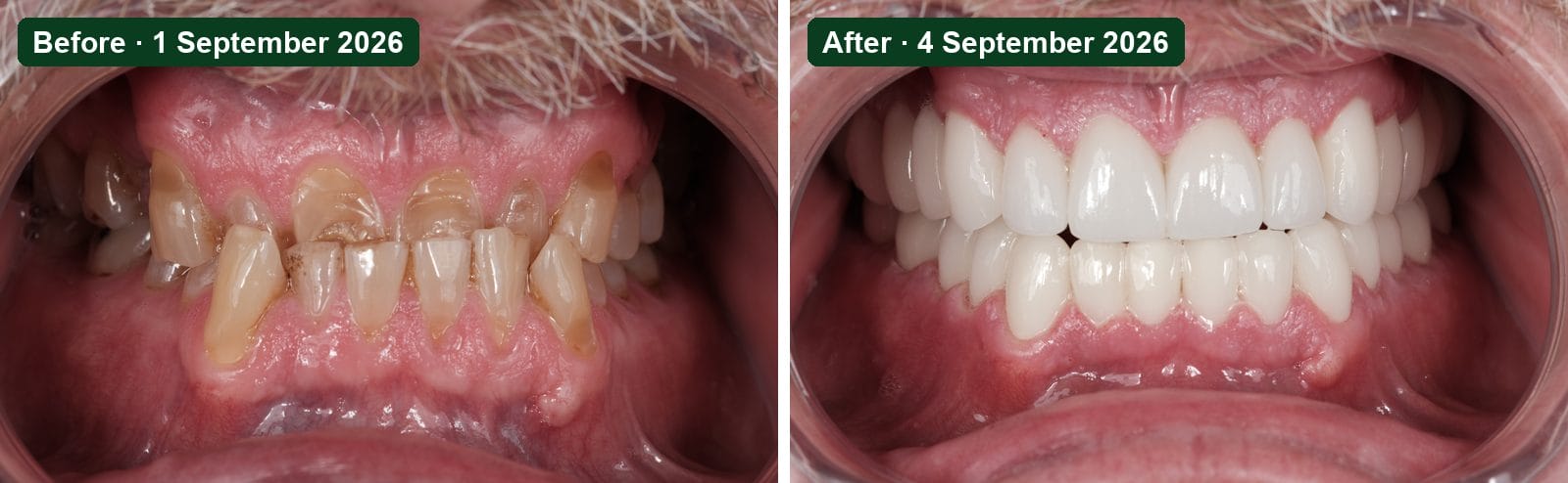 Smile Dental Turkey Front view before and after: short, worn and stained upper teeth with the lower teeth closing in front on 1 September 2026, and 28 porcelain crowns with the upper teeth closing in front on 4 September 2026