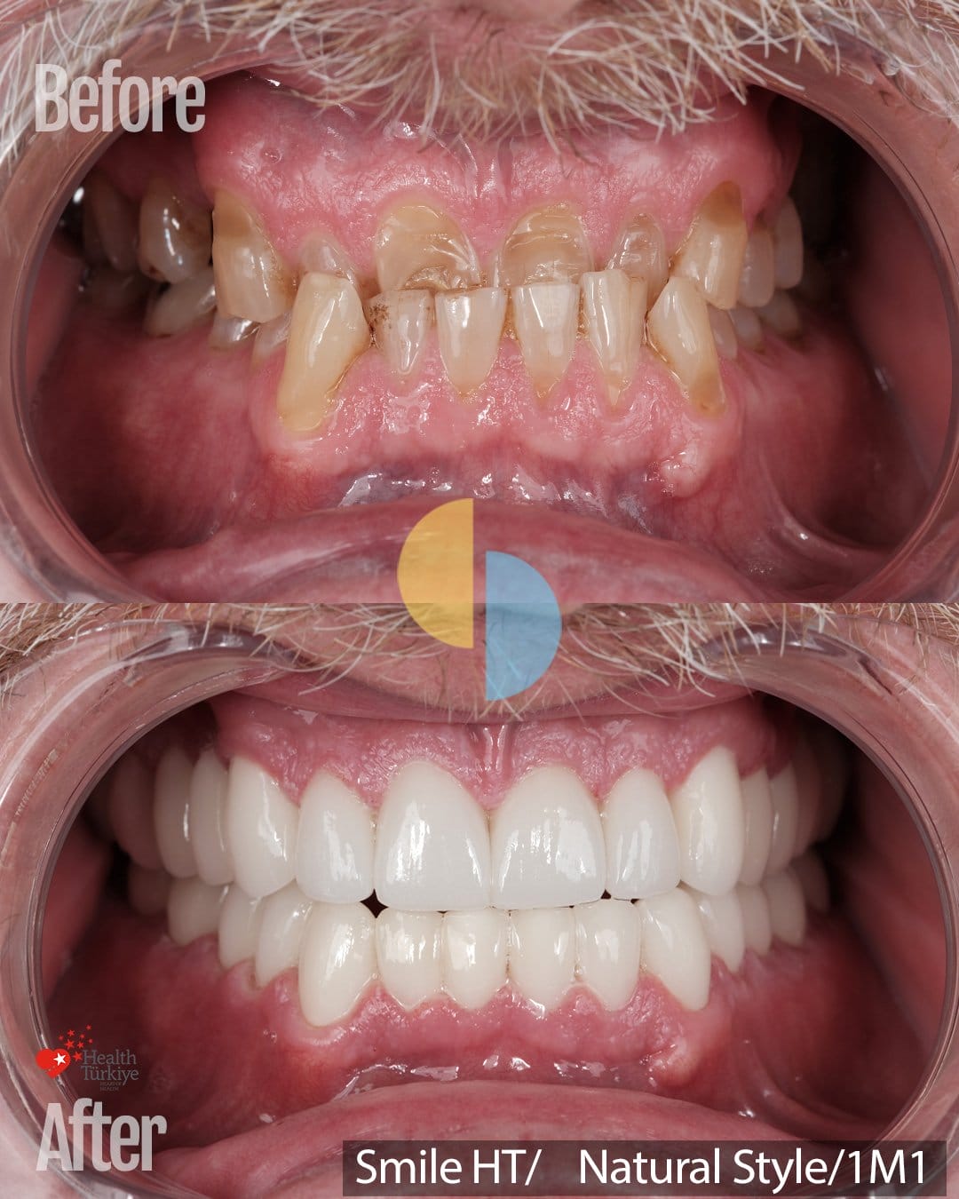 Smile Dental Turkey Retracted before and after view: worn, stained upper teeth sitting behind the lower teeth, and 28 high translucency zirconium crowns with a corrected bite
