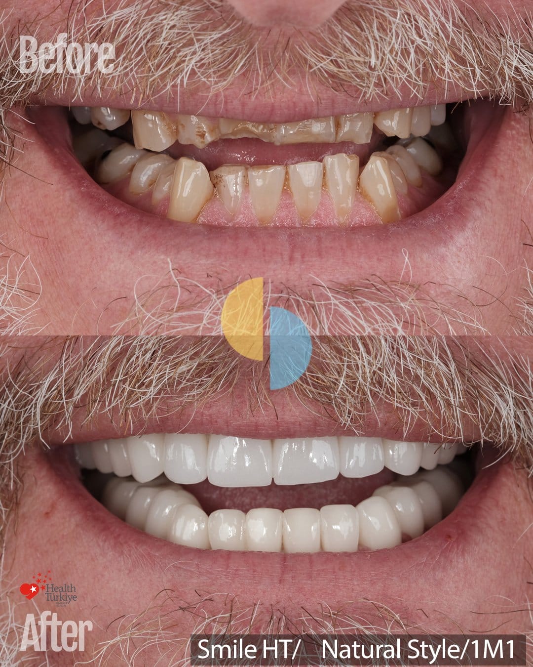 Smile Dental Turkey Smiling front view before and after underbite and worn teeth treatment with porcelain crowns in Turkey