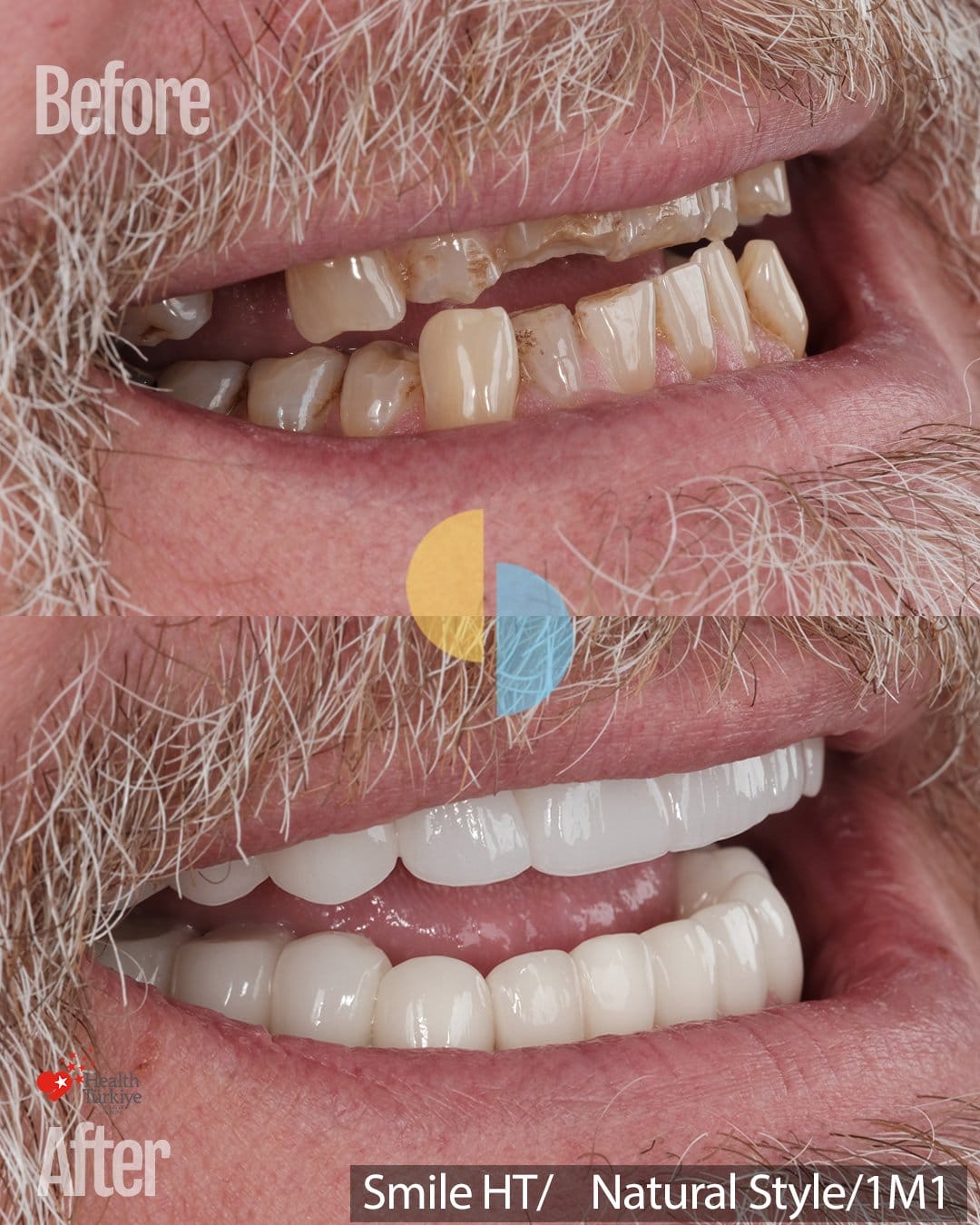Smile Dental Turkey Side view of the smile before and after 28 porcelain crowns, showing the new length of the upper teeth