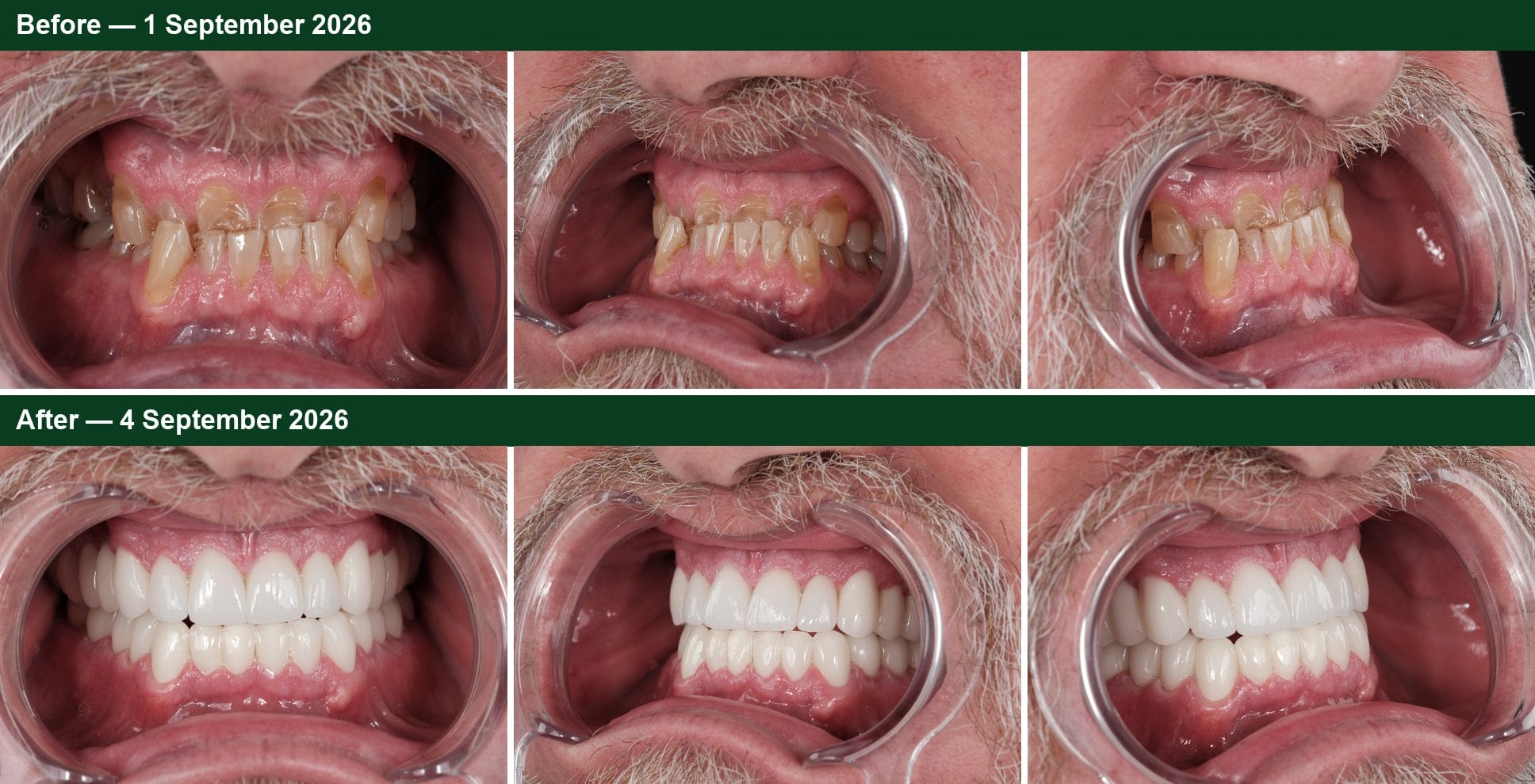 Smile Dental Turkey Before and after from three angles: worn, short upper teeth with an underbite, and 28 porcelain crowns in shade 1M1 with the upper teeth closing in front